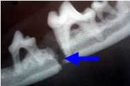 Mandibular fracture, jaw weakened due to advanced periodontitis